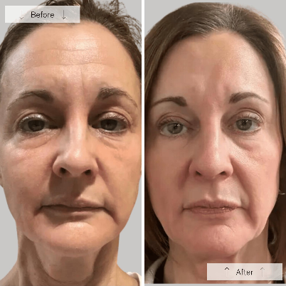 Omnilux Contour face
